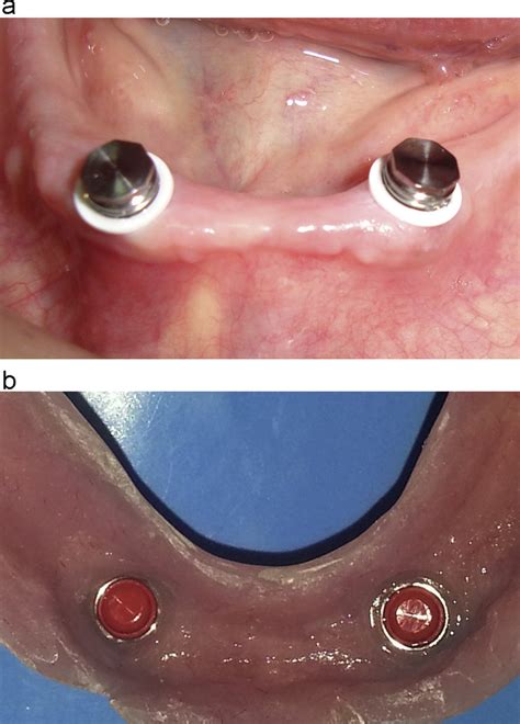 metal housing denture|metal dentures problems.